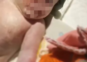 Bayi Asal Muba yang Lahir dengan Kondisi Bermata Satu Dinyatakan Meninggal Dunia